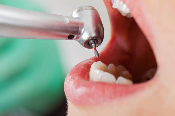Best Emergency Dentist for Lost Fillings or Crowns in Clinton, TN